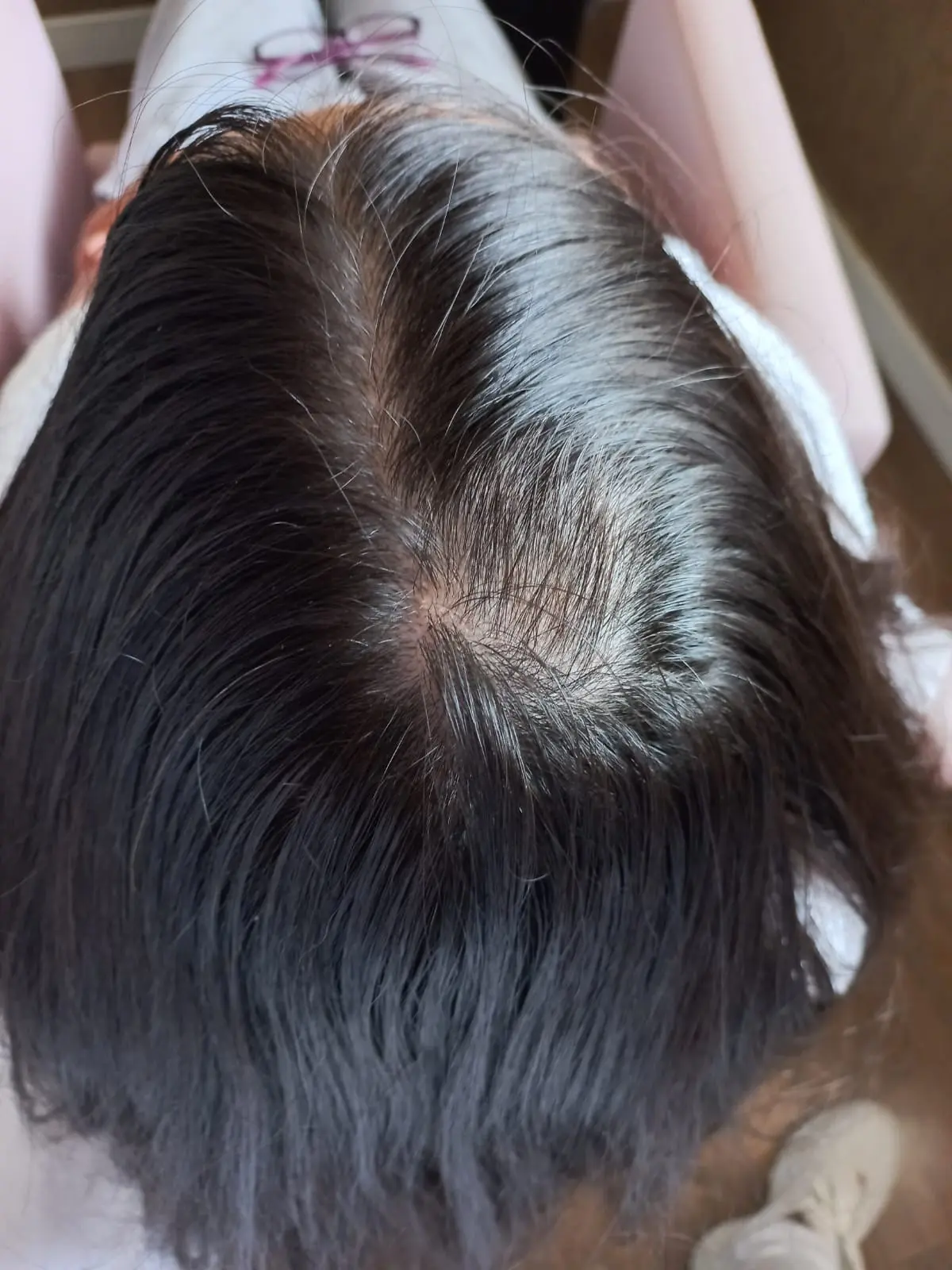 Alopecia Areata (1)