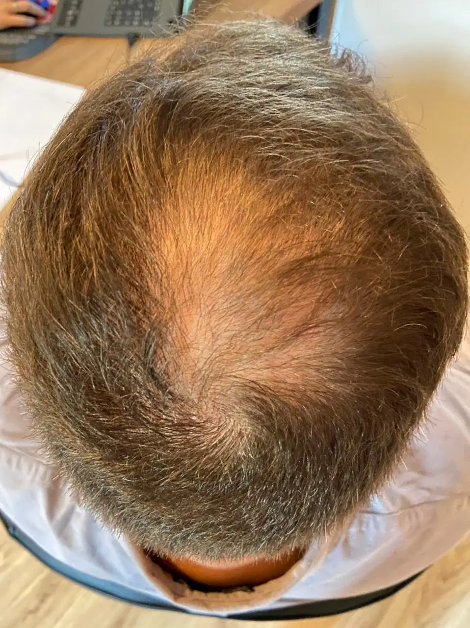 Alopecia androgenética foto 1