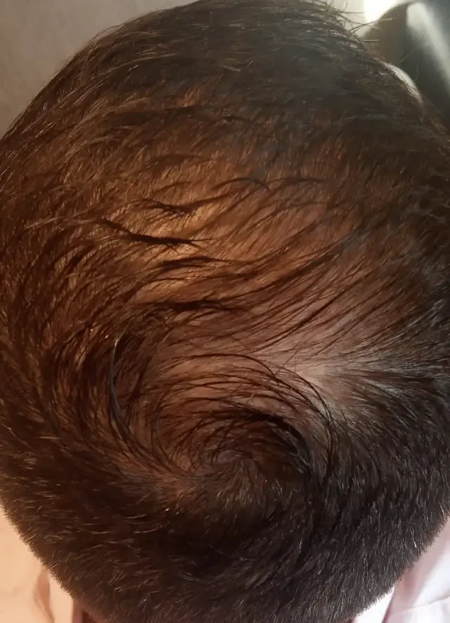 Alopecia androgenética foto 2