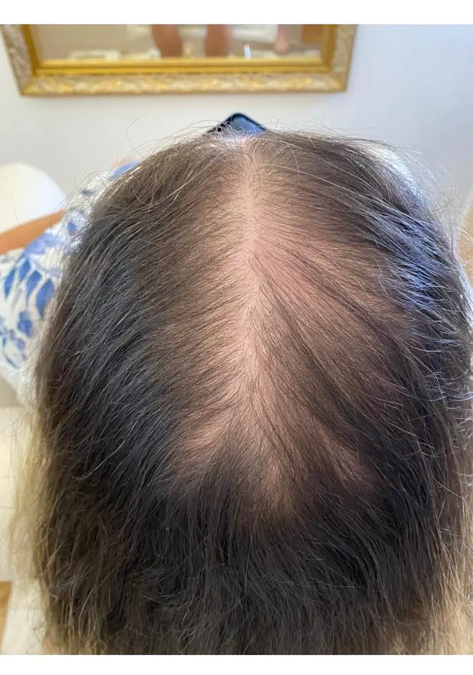 Alopecia padrão feminino 1