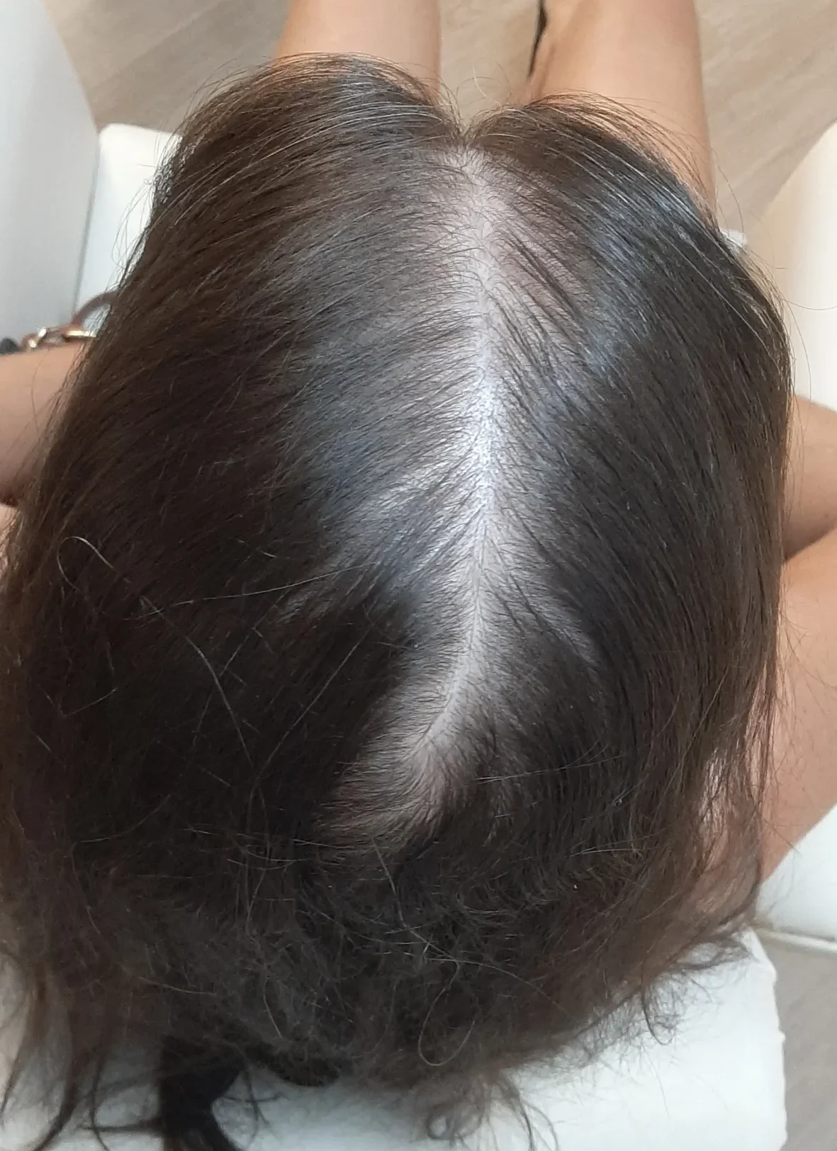 Alopecia padrão feminino 2